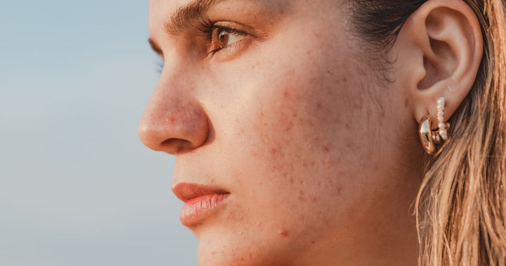 Wat zijn de oorzaken van acne?