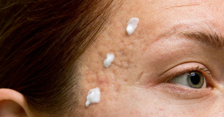 Bye Bye hormonale acne: 6 tips om ze te verminderen!